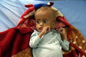 Govt to launch nutrition drive for severely acute malnourished children 1 07child