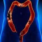 colorectal cancer